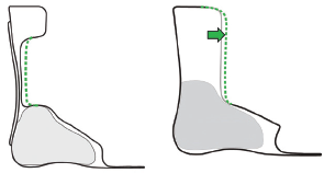 Diagram of trimlines posterior and trimlines anterior options