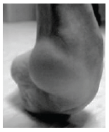 Pictured a club foot