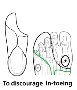 Diagram showing plantar surface trimmed proximal to the 1st and 2nd met heads