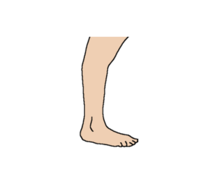 Marked plantarflexion
