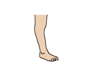 Marked knee hyperextension of a couple degrees