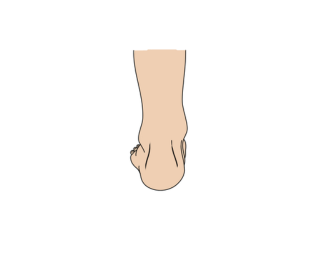 Regular or slight eversion