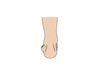 Regular or slight inversion/eversion 