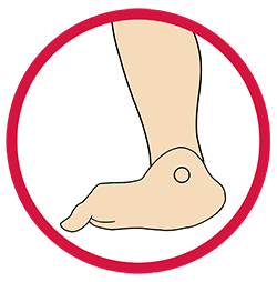 This image showcases the structure of the foot that is suffering from Positioning. 
