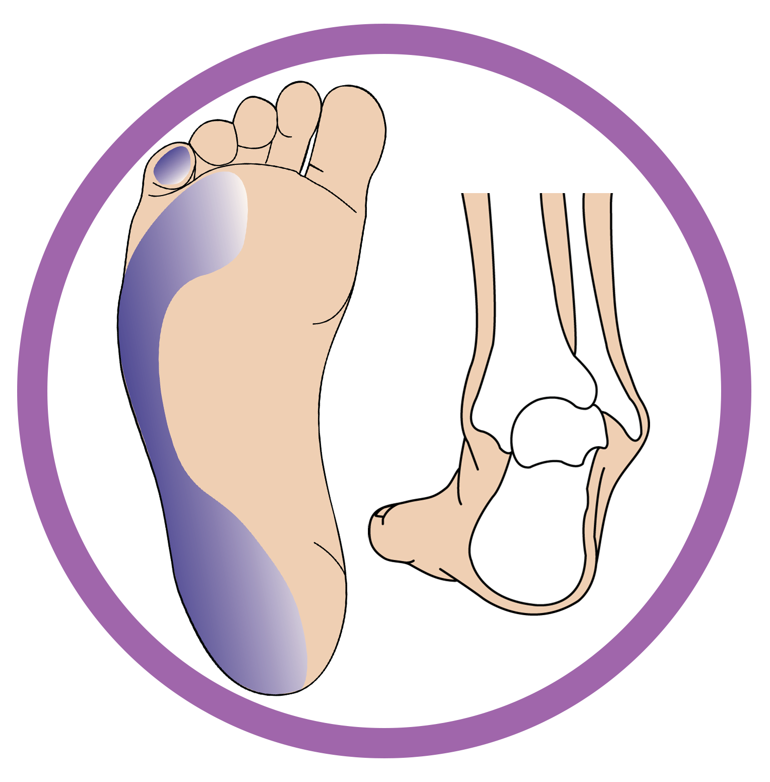 This image showcases the structure of the foot that is suffering from High tone pronation/Supination