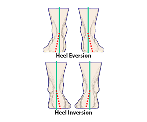 This image shows a foot with heel eversion