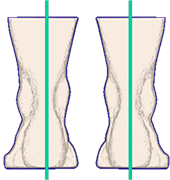 Vertical Hindfoot